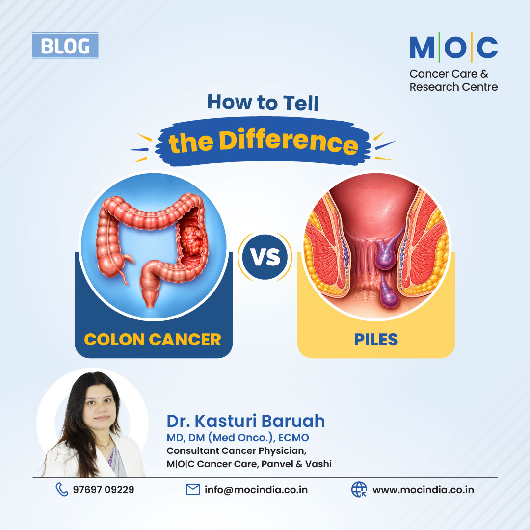 Colon Cancer vs Piles: How to Tell the Difference